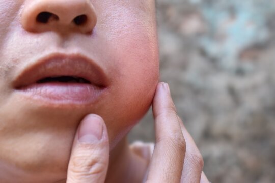 Surge In Mumps Cases Raises Concerns Among City Hospitals In Pune