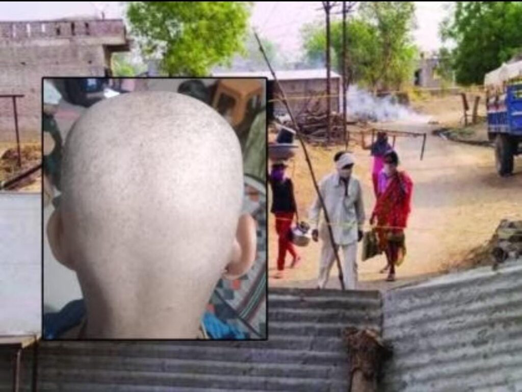 Mysterious Hair Loss Outbreak Sparks Fear In Buldhana - PUNE PULSE